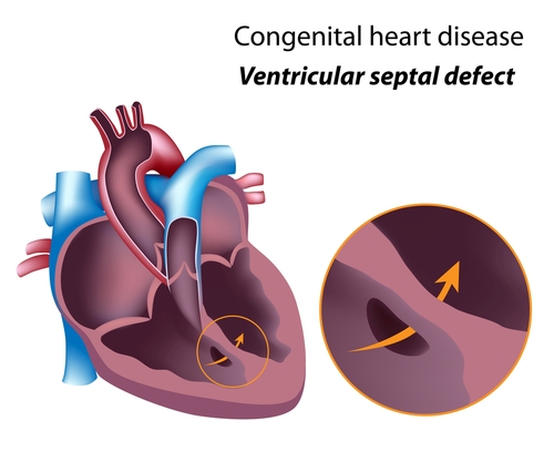 hole in the heart valve