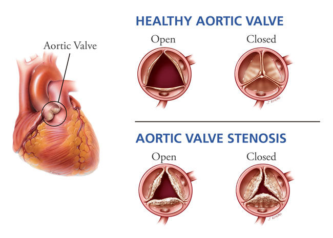 stenosis of heart valve